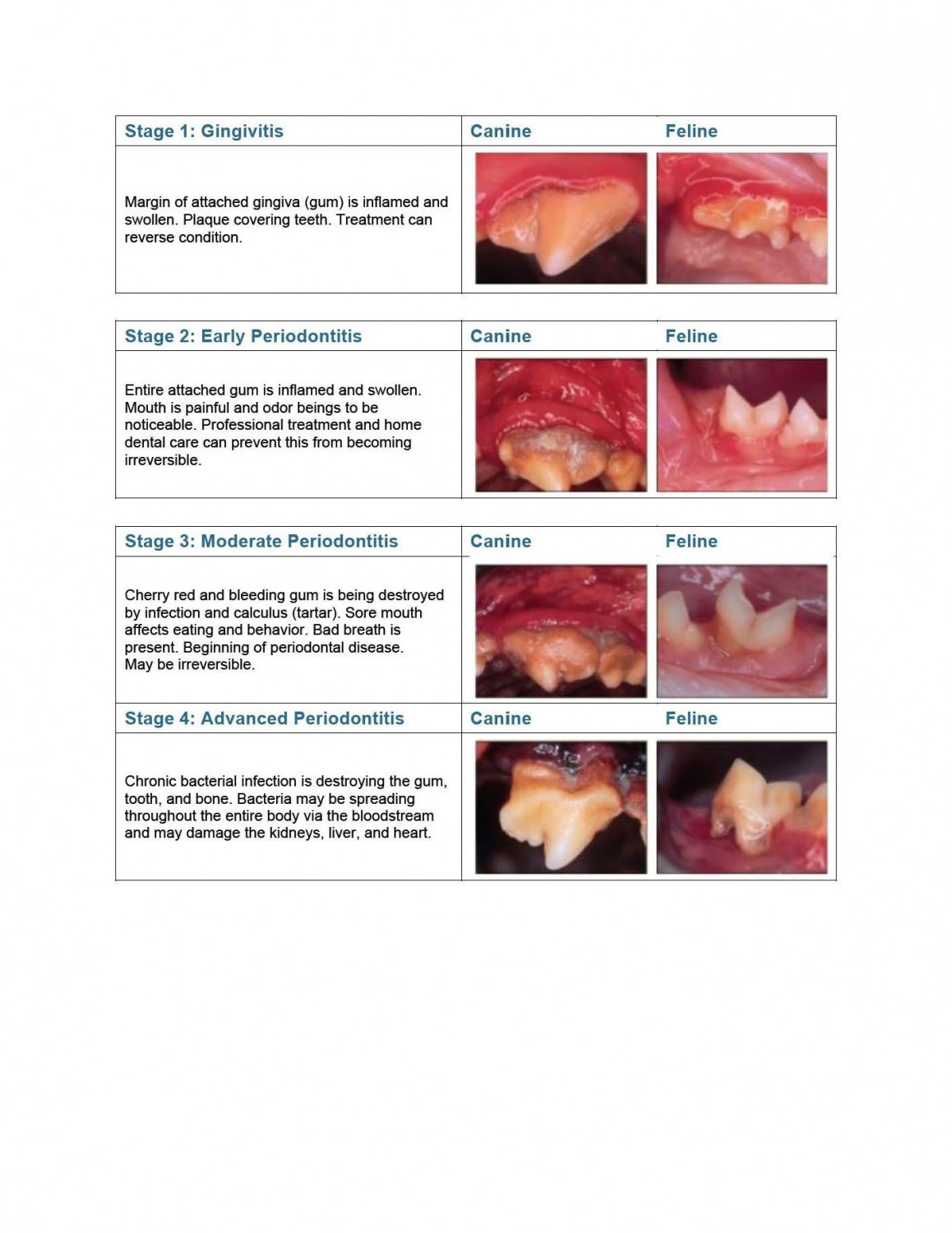 4 Stages of Periodontis